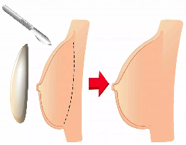 Breast Augmentation