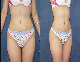 Liposuction