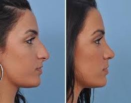 Rhinoplasty