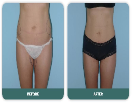 Liposuction