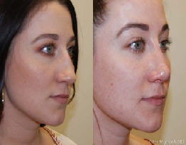 Rhinoplasty