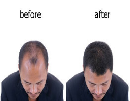 Hair Transplantation