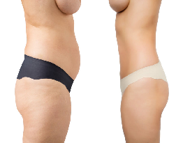 Liposuction and Body Contouring