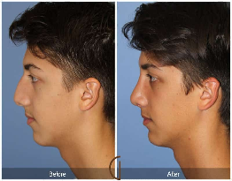 Rhinoplasty