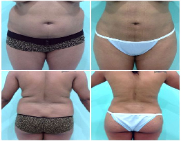 Liposuction