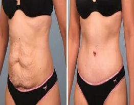 Liposuction