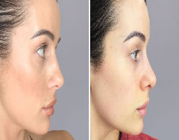 Rhinoplasty