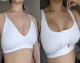 Breast Augmentation