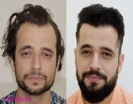 Hair Transplantation