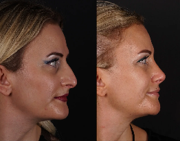 Rhinoplasty