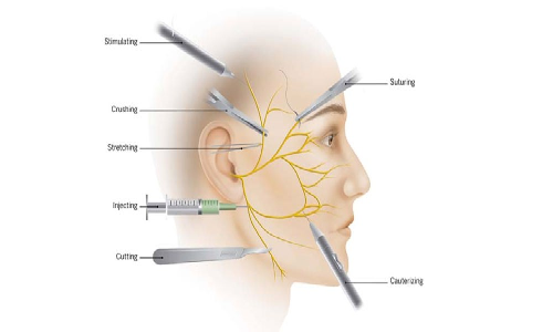 Nerve damage risk