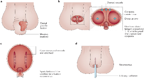 Infection risk