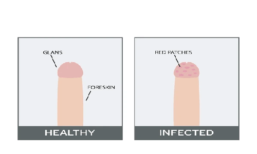 Infection risk