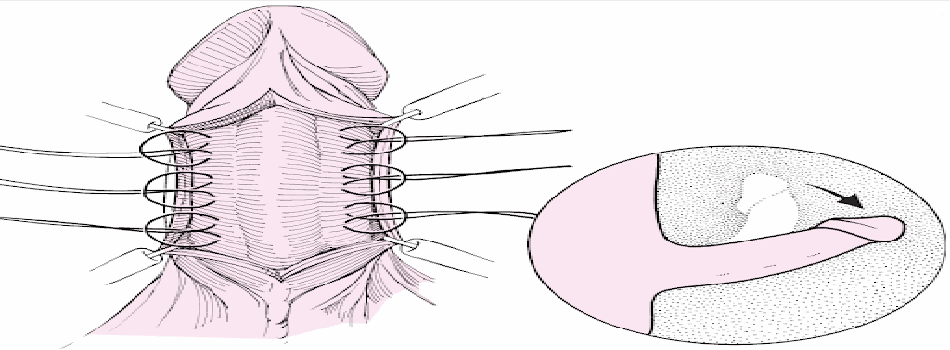 Penile Lengthening Surgery Banner