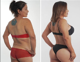 Brazilian Butt Lift