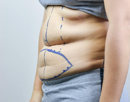 coolsculpting