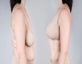 Breast Augmentation