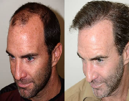 Hair Transplantation