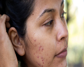 Acne Scars