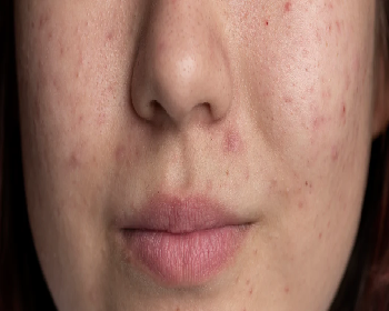 Blemishes and Uneven Skin Texture