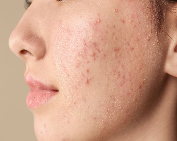 Persistent Acne