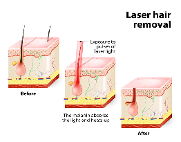 Laser Hair Treatment