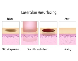 Laser Treatment