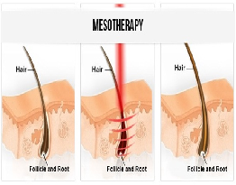 Mesotherapy Treatment