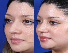 Rhinoplasty