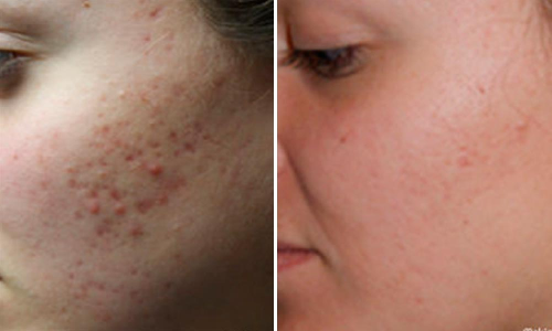 Acne and Acne Scars