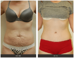 Tummy Tuck